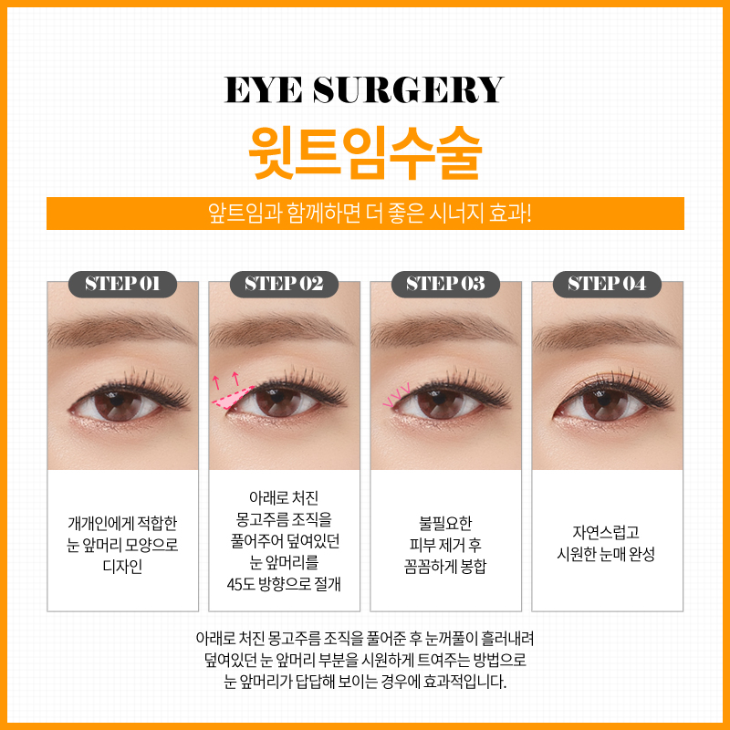 쌍꺼풀수술? 트임수술? 나에게 맞는 눈성형은? 관련 이미지 15
