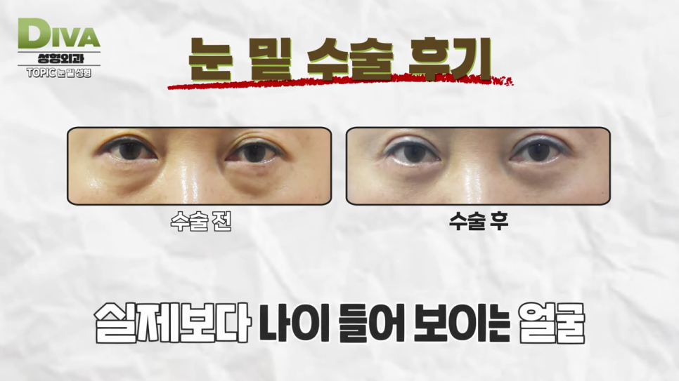 눈지방이식 어린 느낌을 살려 관련 이미지 8