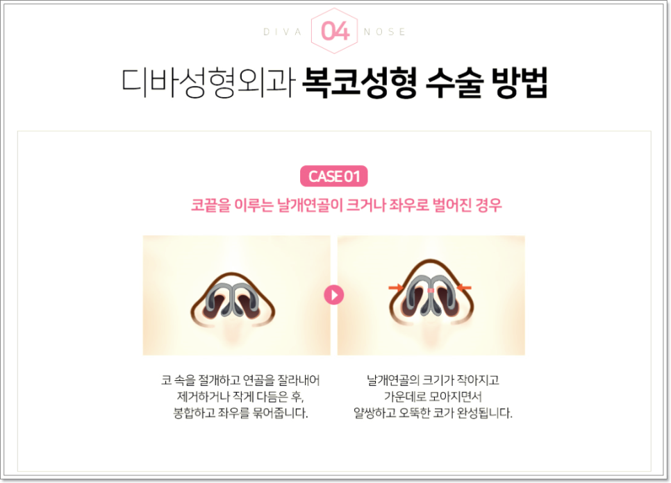 복코성형외과 진짜가 나타났다! 관련 이미지 4