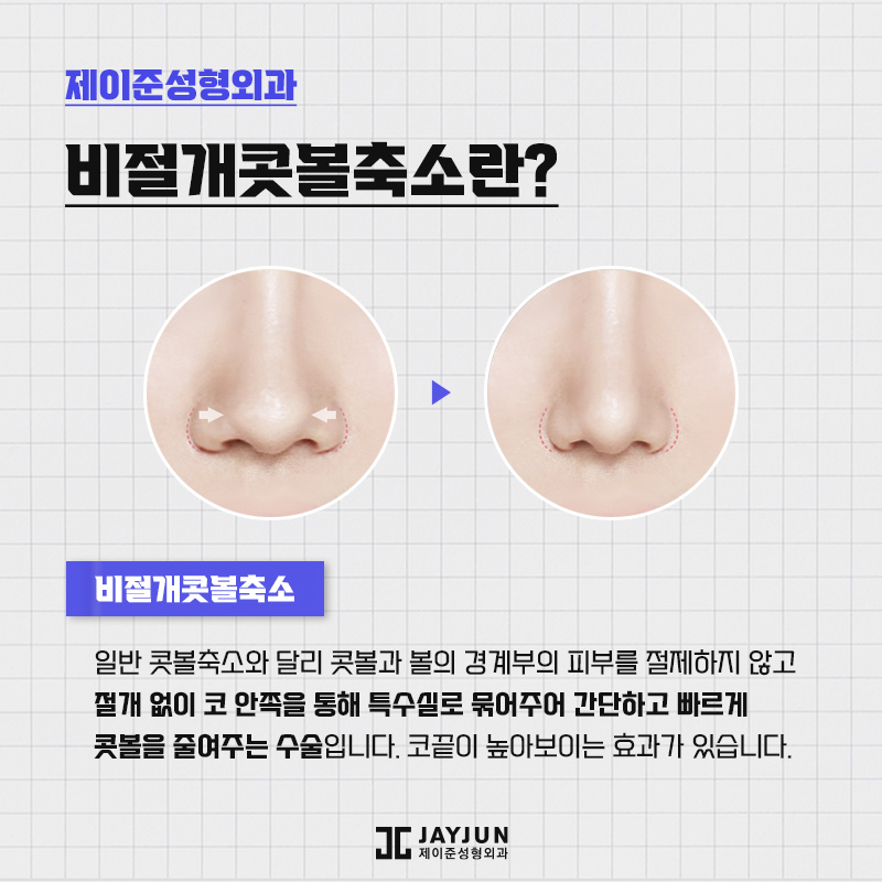제이준의 비절개콧볼축소 , 콧볼축소 차이점 관련 이미지 3