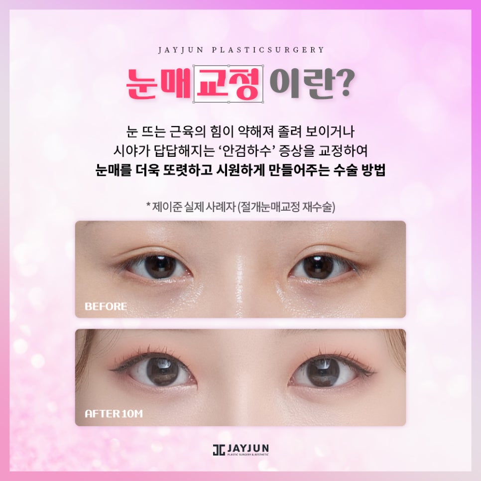 생기있고! 또렷하게! 제이준 눈매교정 관련 이미지 2