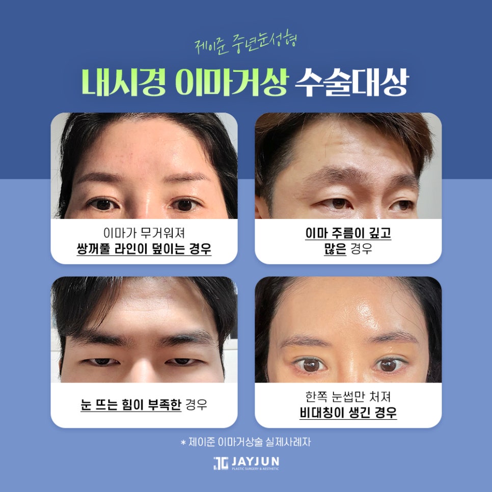 [제이준 성형외과] 이마 주름과 처진 눈매 개선에는! 제이준 중년눈성형 내시경 이마거상 관련 이미지 3