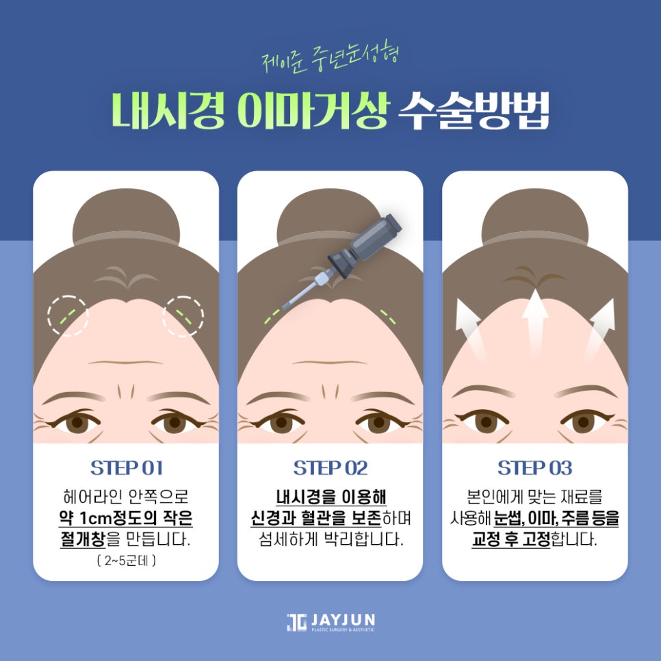 [제이준 성형외과] 이마 주름과 처진 눈매 개선에는! 제이준 중년눈성형 내시경 이마거상 관련 이미지 4