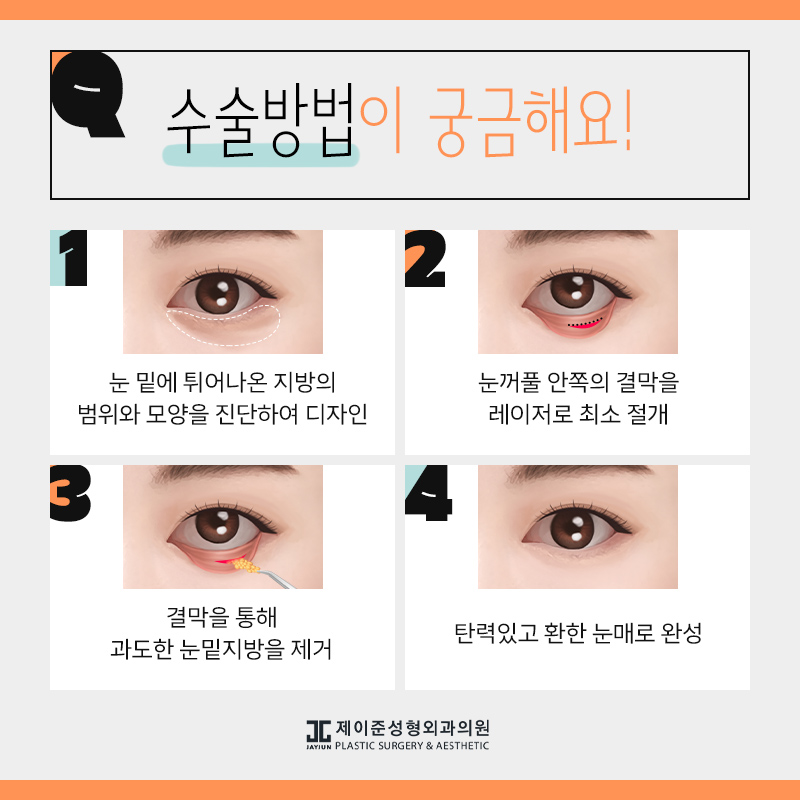 눈밑지방제거 알아보시나요? 관련 이미지 4