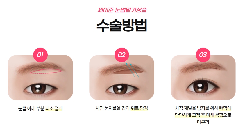 [제이준성형외과&middot;피부과] 쌍꺼풀 라인 변화 없이 눈매 개선은 확실하게! #눈썹밑거상 관련 이미지 7
