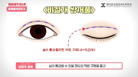 [제이준성형외과&middot;피부과] 비절개&middot;부분절개&middot;절개 쌍꺼풀의 원리와 차이점! 관련 이미지 5