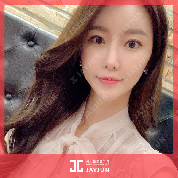 강남역피부과 입꼬리보톡스 + 용량무제한 입술필러 이벤트 한대요!? 관련 이미지 5