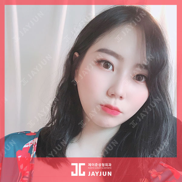 제이준피부과, 강남 입술필러 용량이 무제한이라고?! 관련 이미지 2
