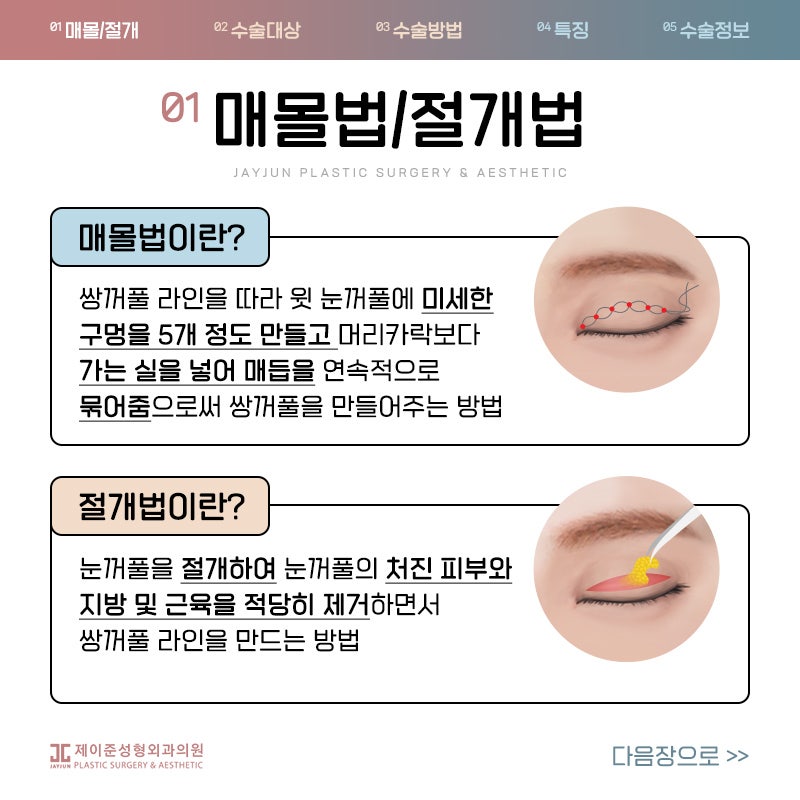 쌍꺼풀수술 매몰과 절개 어떤수술? 관련 이미지 2