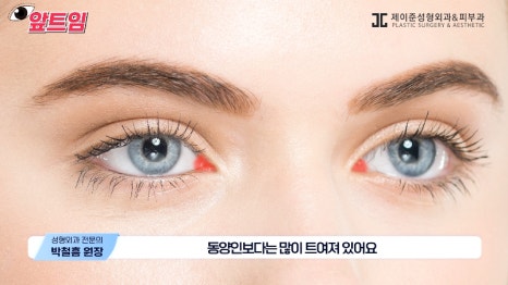 [Jaejune Plastic Surgery & Dermatology] Why is epicanthoplasty necessary? Everything about epicanthoplasty!! image 21