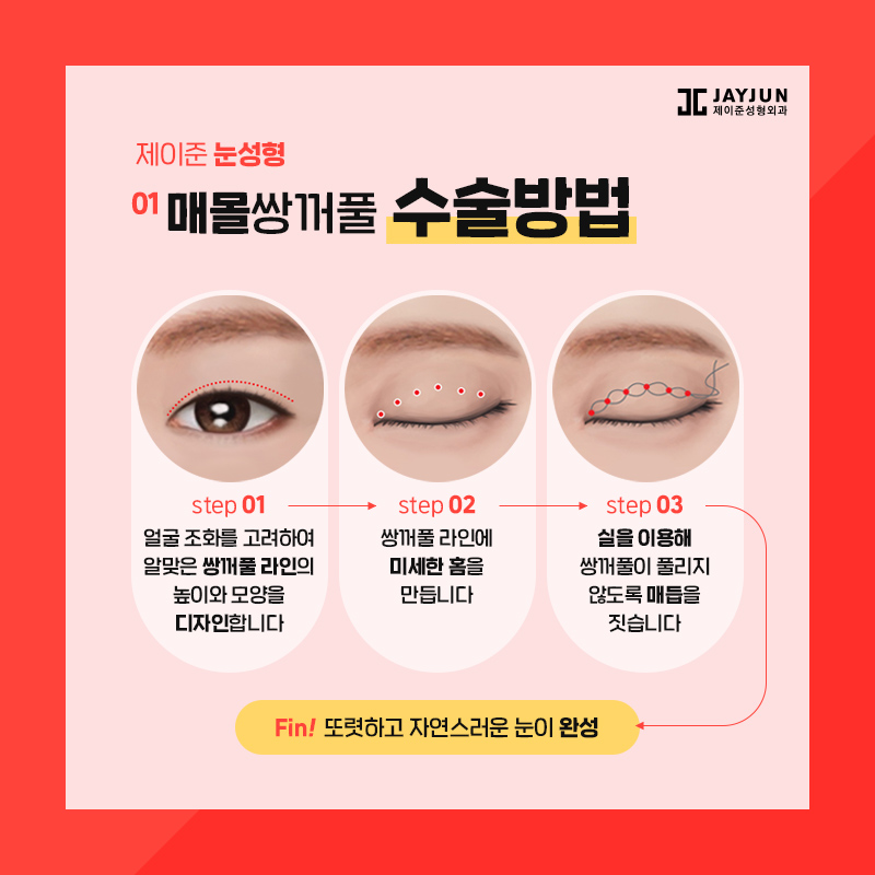 쌍꺼풀수술 종류 알아보기 관련 이미지 3