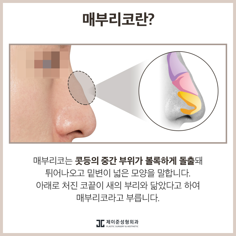 매부리코 교정 , 유형과 상태에 따라 진행돼야 관련 이미지 2