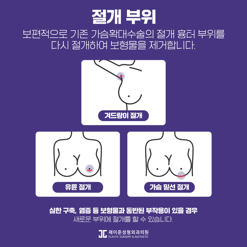 가슴보형물제거 어떤 수술일까? 관련 이미지 3