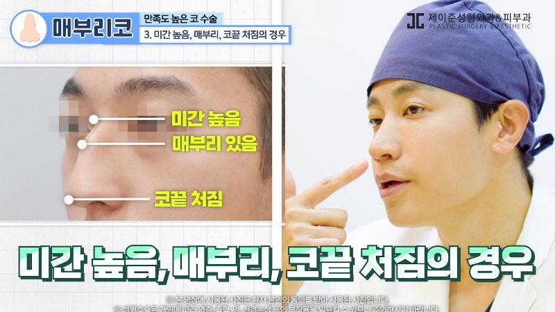 [제이준 유튜브] 유형별 코 성형, 가장 만족도 큰 매부리 코! 관련 이미지 10
