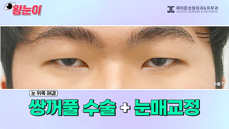 [제이준성형외과&middot;피부과] 제이준성형외과 박철흠 원장님이 알려주는 눈이 커지는 방법 핵심요약! 관련 이미지 13