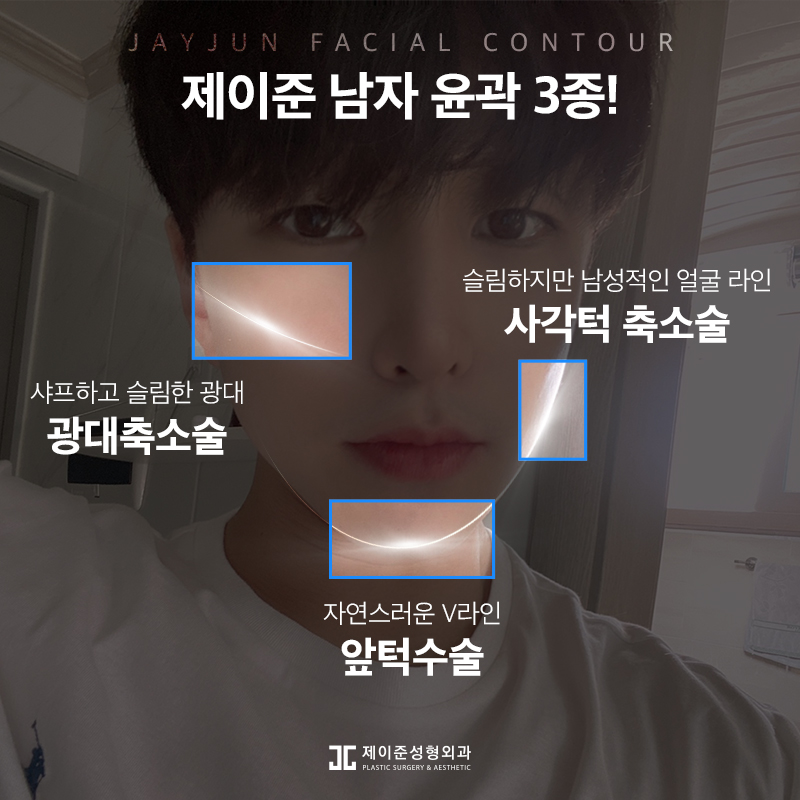 남자안면윤곽술, 부드럽고 샤프한 인상으로! 관련 이미지 2