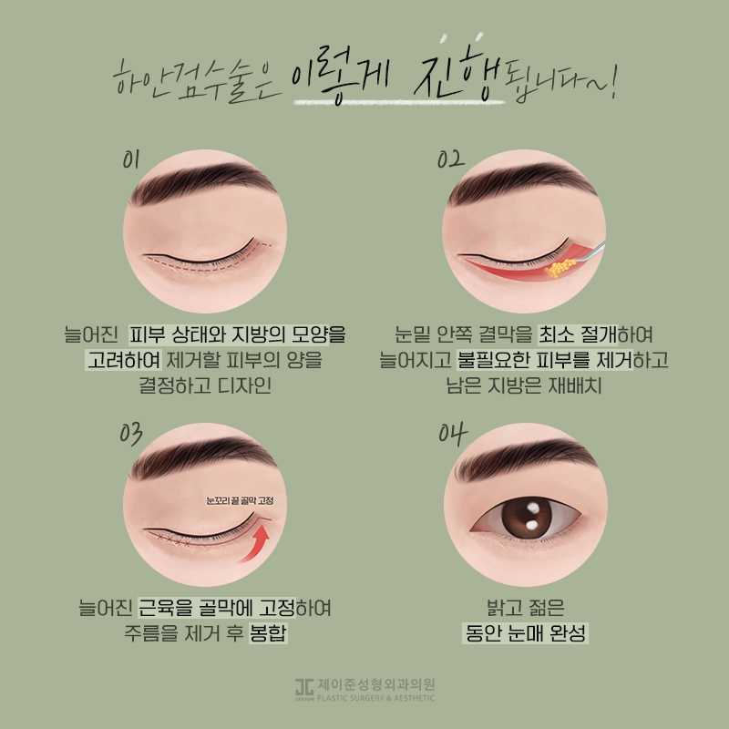 상안검과 하안검이란? 관련 이미지 7