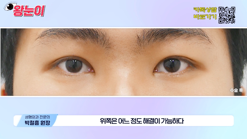 [제이준성형외과&middot;피부과] 제이준성형외과 박철흠 원장님이 알려주는 눈이 커지는 방법 핵심요약! 관련 이미지 14