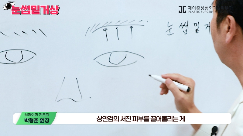 [제이준성형외과&middot;피부과] 쌍꺼풀 라인 변화 없이 눈매 개선은 확실하게! #눈썹밑거상 관련 이미지 2