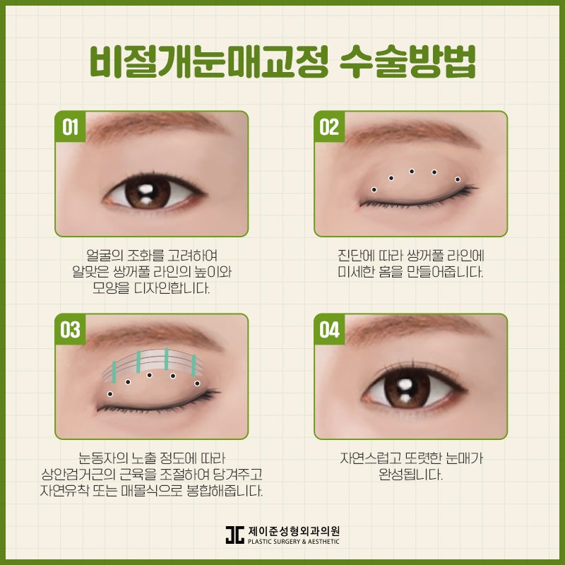 눈매교정 , 절개 / 비절개 차이점은? 관련 이미지 5
