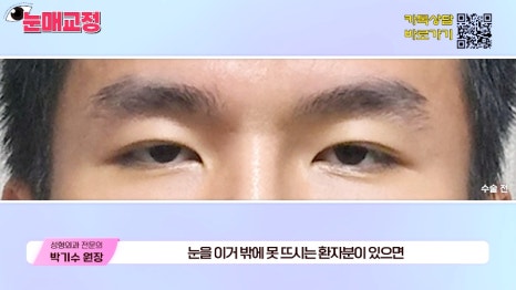 [제이준성형외과&middot;피부과] 눈매교정 파헤치기! 하나부터 열까지 싹~ 알려드립니다! 관련 이미지 2