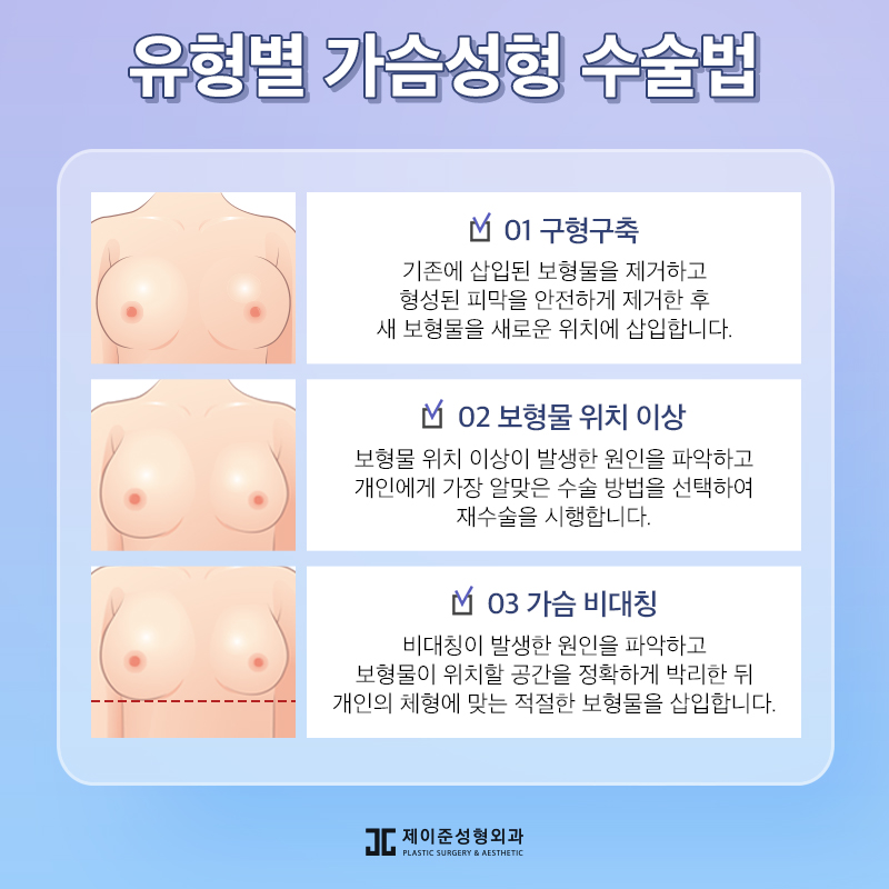 가슴재수술 , 실패 원인에 따른 수술 계획이 중요 관련 이미지 4