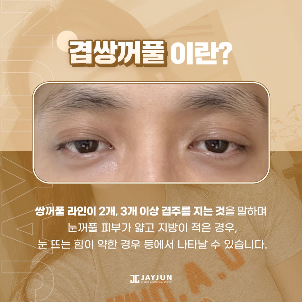 피곤한 인상! 흐릿한 눈매! 제이준 #겹쌍꺼풀 눈성형 관련 이미지 2