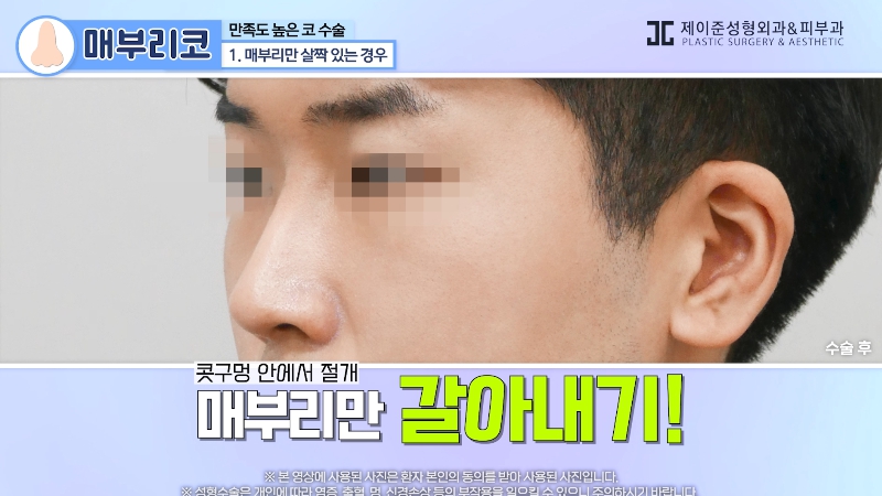 [제이준 유튜브] 유형별 코 성형, 가장 만족도 큰 매부리 코! 관련 이미지 7