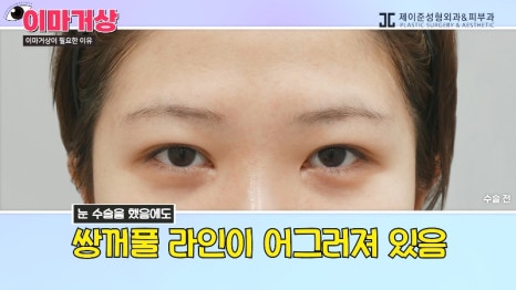 [제이준 유튜브] 쌍수 하러  갔는데 이마거상을 추천하는 이유?! 관련 이미지 7