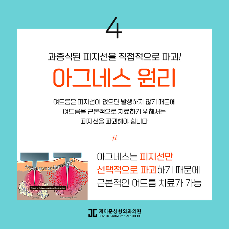 아그네스 , 여드름을 박멸시키고 싶다면! 관련 이미지 5