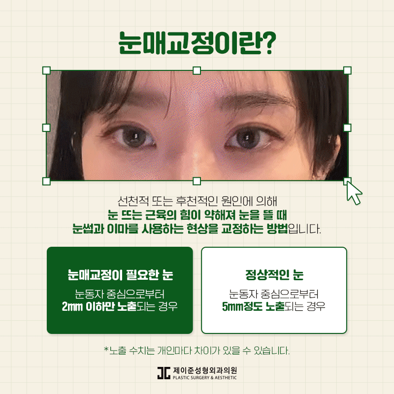 눈매교정 , 절개 / 비절개 차이점은? 관련 이미지 2