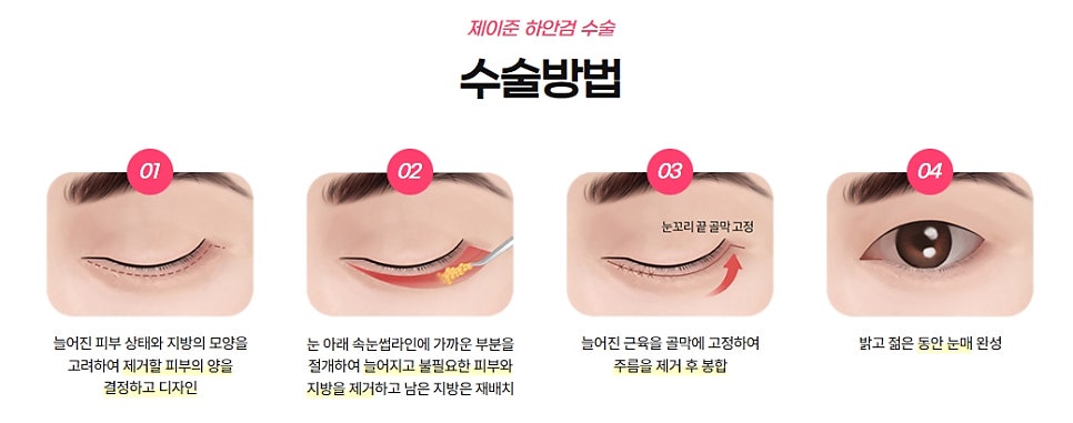 [제이준 유튜브] 하안검 무엇이든 물어보세요! 관련 이미지 2