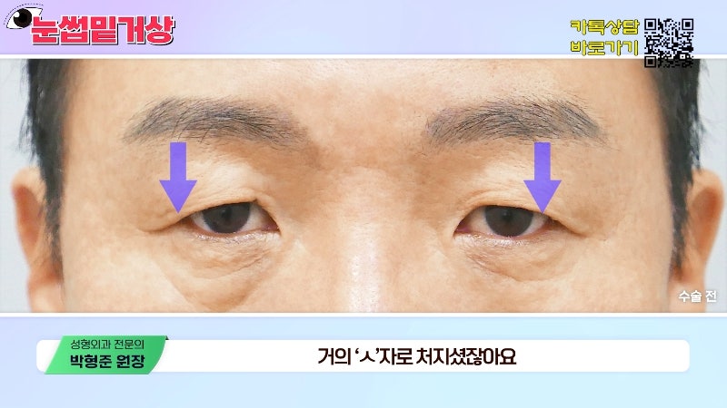 [Jayjun Plastic Surgery & Dermatology] Worried about drooping eyelids? Solve sagging eyes with a brow lift under the eyebrows without double eyelid surgery! image 18