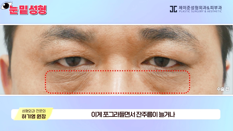 [Jeijun Plastic Surgery & Dermatology&middot;] Lower Blepharoplasty? Lower Eyelid Fat Repositioning? Read This Before Deciding! image 8