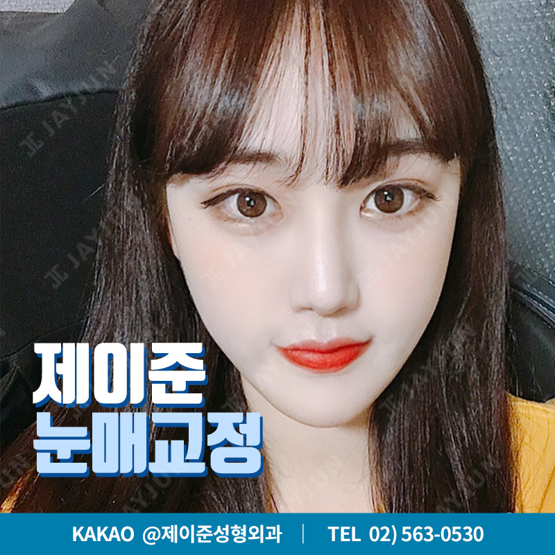 맞춤 눈매교정 눈성형을 원한다면 ? 제이준성형외과에서 ! 관련 이미지 1