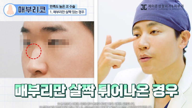 [제이준 유튜브] 유형별 코 성형, 가장 만족도 큰 매부리 코! 관련 이미지 6