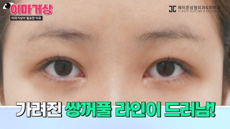 [제이준 유튜브] 쌍수 하러  갔는데 이마거상을 추천하는 이유?! 관련 이미지 8