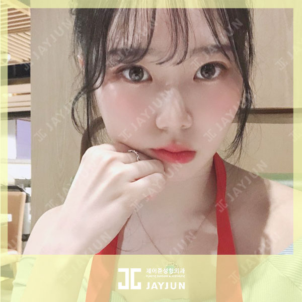 울쎄라 비용 가격 알아보는 방법 관련 이미지 4