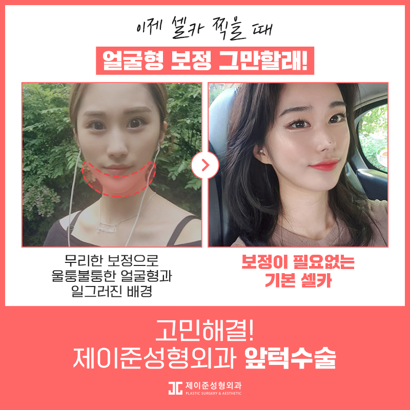 갸름한 얼굴형을 위한 앞턱수술 관련 이미지 2