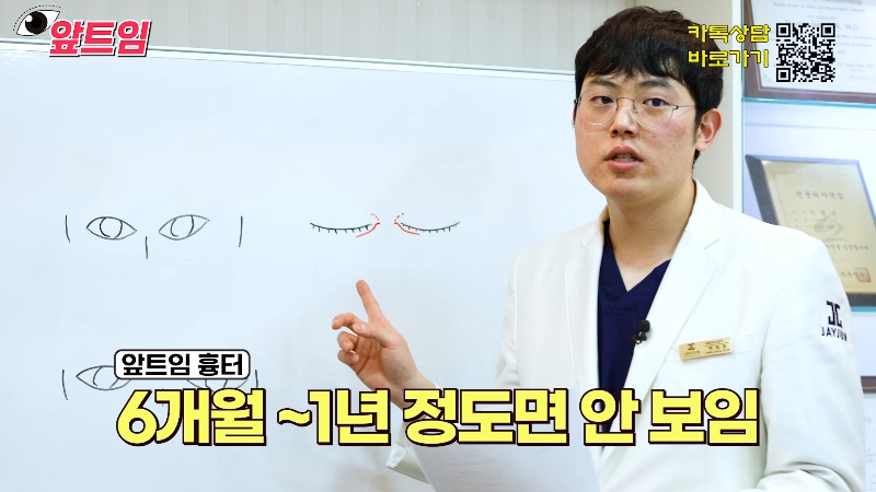[Jaejune Plastic Surgery & Dermatology] Why is epicanthoplasty necessary? Everything about epicanthoplasty!! image 30