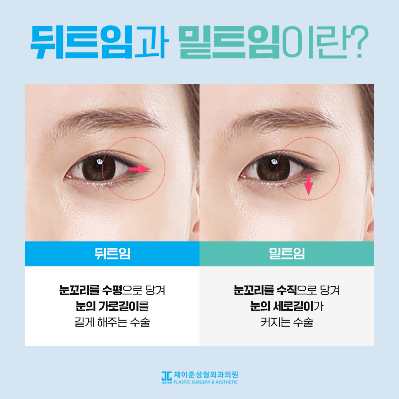 뒤트임과 밑트임이란? 관련 이미지 2