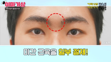 [제이준 유튜브] 쌍수 하러  갔는데 이마거상을 추천하는 이유?! 관련 이미지 12