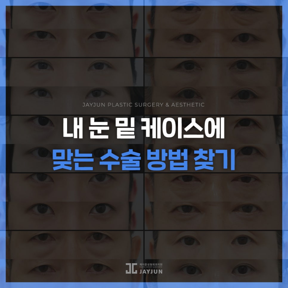 [Jaejun Plastic Surgery & Dermatology] Under-eye fat: Under-eye fat repositioning vs. lower blepharoplasty — which procedure is right for me? image 7