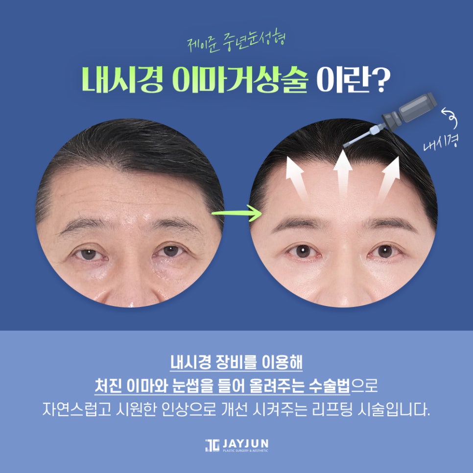[제이준 성형외과] 이마 주름과 처진 눈매 개선에는! 제이준 중년눈성형 내시경 이마거상 관련 이미지 2