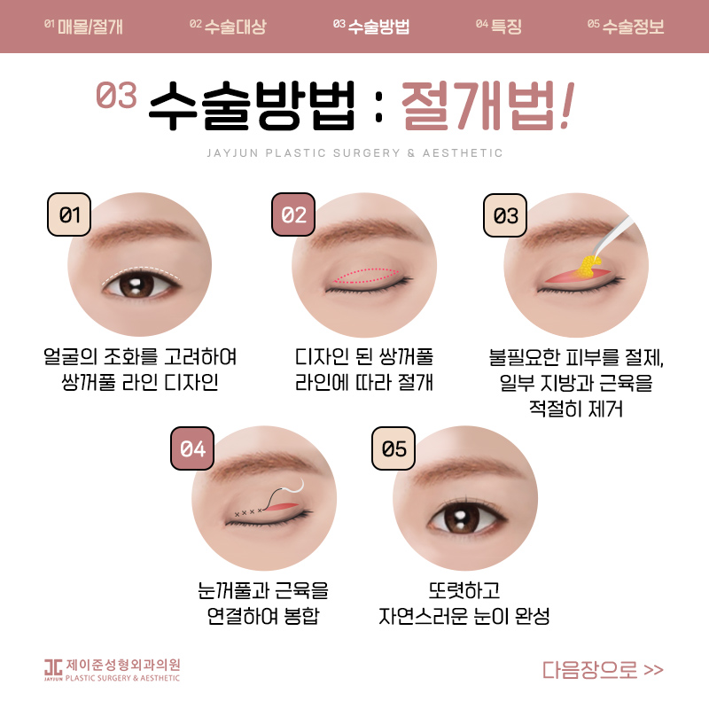 쌍꺼풀수술 매몰과 절개 어떤수술? 관련 이미지 5