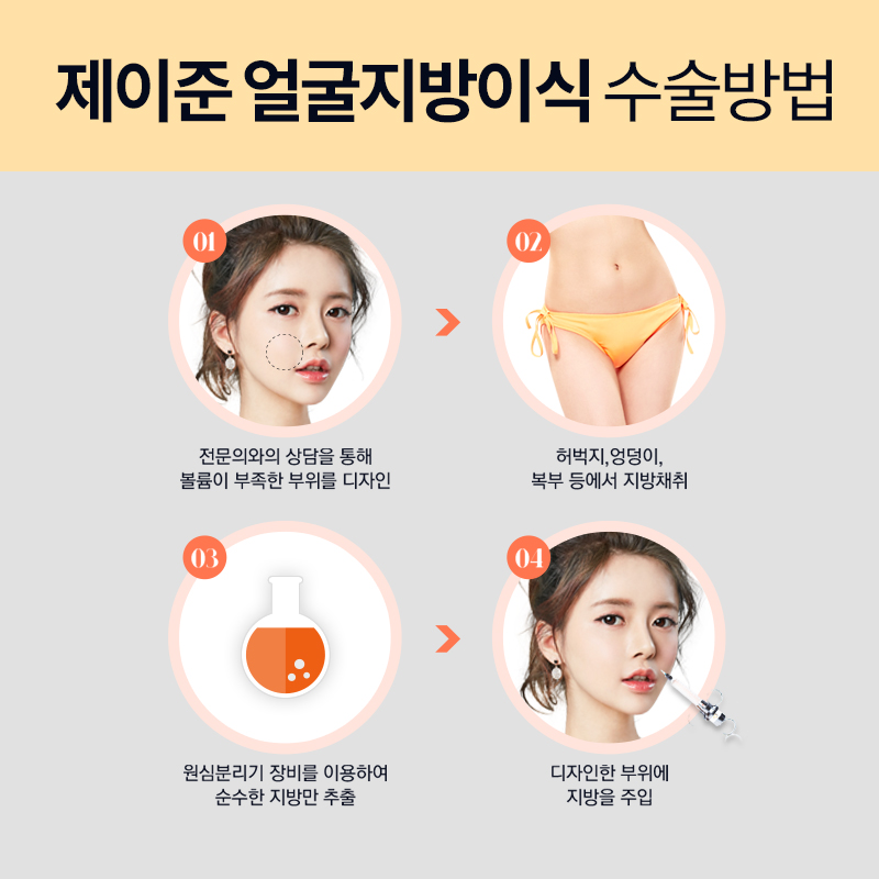 역삼역 제이준성형외과, 얼굴지방이식 비율까지 생각해! 관련 이미지 3