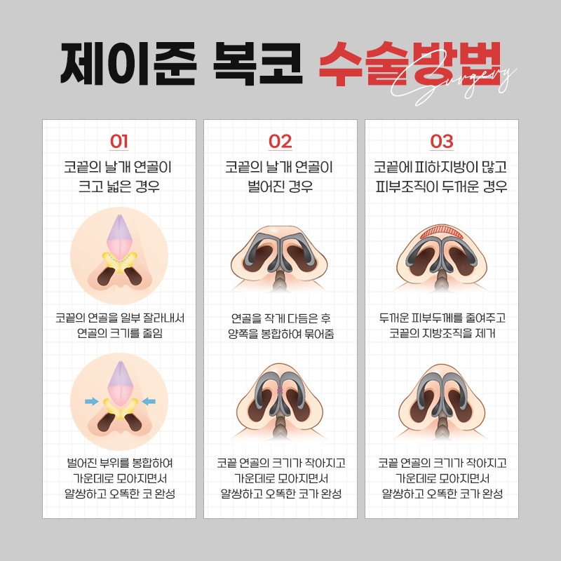 뭉툭한 복코를 개선하는 제이준 복코성형 관련 이미지 5