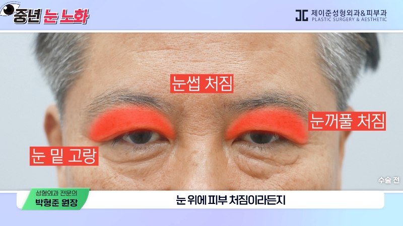 [제이준성형외과&middot;피부과] 🚨성형외과 전문의가 알려주는 눈 노화 신호🚨 관련 이미지 15