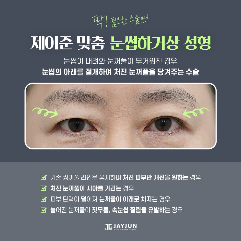 [제이준 성형외과] 미용+기능 동시에 잡는 제이준 중년 눈성형 관련 이미지 5