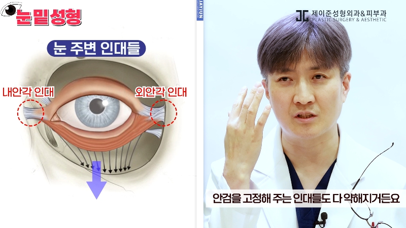 [Jeijun Plastic Surgery & Dermatology&middot;] Lower Blepharoplasty? Lower Eyelid Fat Repositioning? Read This Before Deciding! image 6